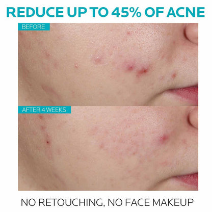 La Roche-Posay Effaclar 1.5% Salicylic Acid Serum, Acne Treatment For Face With Glycolic Acid & Niacinamide, Acne Serum Helps Clear Blackheads, Whiteheads, Pimples & Reduces Post Acne Marks